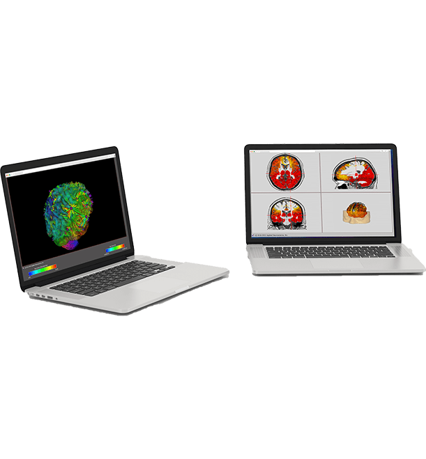 Neurofeedback and LORETA